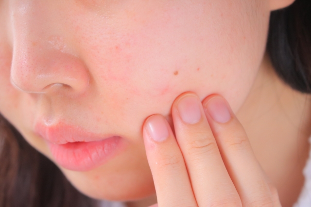 皮膚に赤い血管模様がある方へ